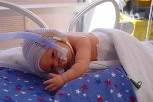Новорожденный ребенок с носовым CPAP